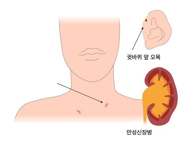아가미-귀-신장 스펙트럼장애 그림-귓바퀴 앞 오목,만성신장병