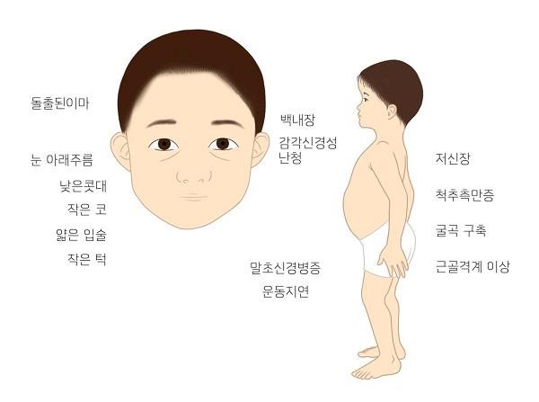 백내장, 성장호르몬 결핍, 감각신경병증, 감각신경성 청력 상실 및 골격 이형성증 증상 그림. 돌출된이마, 눈 아래주름, 낮으느콧대, 작은 코, 얇은 입술, 작으느 턱, 백내장, 감각신경성 난청, 말초신경병증, 운동지연, 저신장, 철추측만증, 굴곡 구축, 근골격계 이상