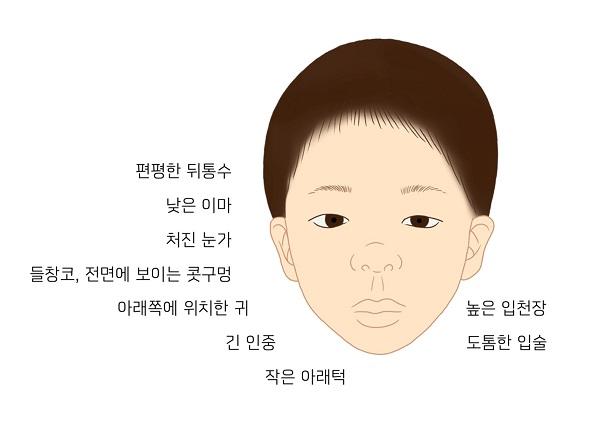 15번 염색체 장완 11-13 부분의 미세중복 증후군 그림: 편평한 뒤통수, 낮은 이마, 처진 눈가, 들창코, 전면에 보이는 콧구멍, 아래쪽에 위치한 귀, 긴 인중, 작은 아래턱, 높은 입천장, 도톰한 입술