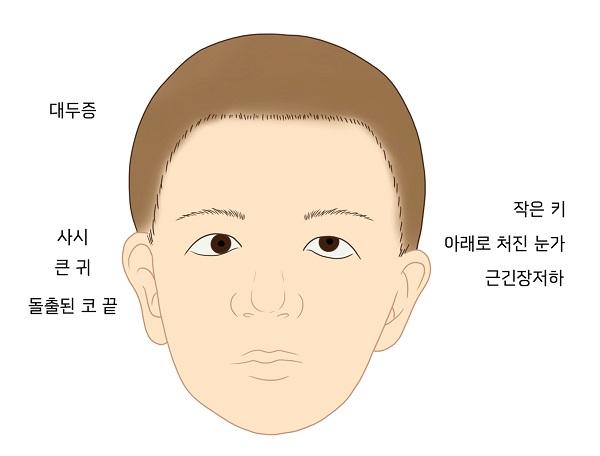 15번 염색체 장완 13.3 부분의 미세결손 그림: 대두증, 사시, 큰 귀, 돌출된 코 끝, 작은 키, 아래로 처진 눈가, 근긴장저하