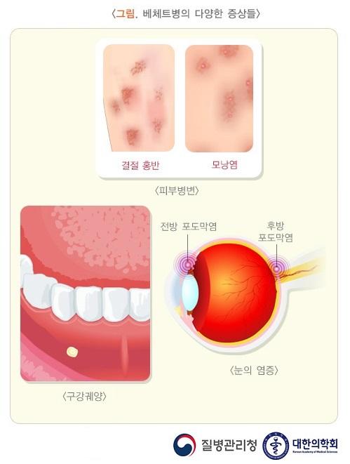 베체트병의 다양한 증상들