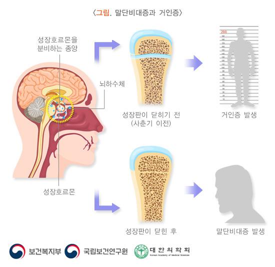말단비대증과 거인증