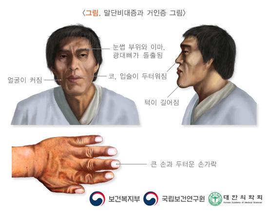 말단비대증과 거인증