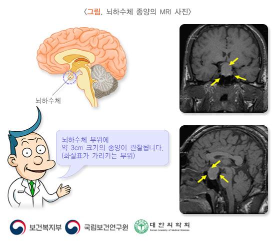 뇌하수체 종양의 MRI 사진