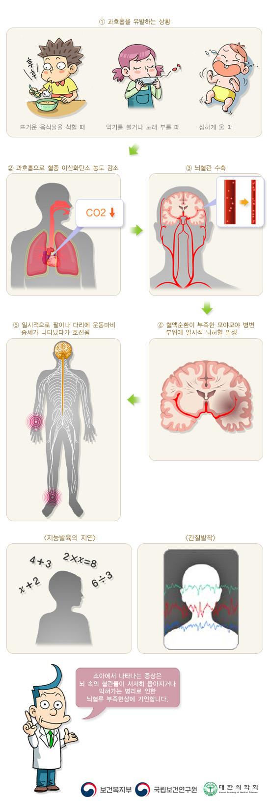 모야모야병 증상 이미지. 1. 과호흡을 유발하는 상황. 뜨거운 음식물을 식힐 때, 악기를 불거나 노래 부를 때, 심하게 울 때. 2. 과호흡으로 혈중 이산화탄소 농도 감소. 3. 뇌혈관 수축. 4. 혈액순환이 부족한 모야모야 병변 부위에 일시적 뇌허혈 발생. 5. 일시적으로 팔이나 다리에 운동마비 증세가 나타났다가 호전됨. 지능발육의 지연, 간질발작. 소아에서 나타나는 증상은 뇌 속의 혈관들이 서서히 좁아지거나 막혀가는 병리로 인한 뇌혈류 부족현상에 기인합니다. 보건복지부, 국립보건연구원, 대한의학회