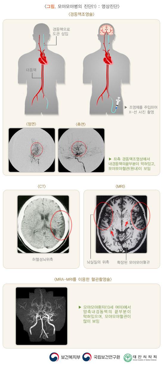 모야모야병의 진단 그림1: 영상진단. 경동맥조영술. 경동맥으로 도관 삽입. 조영제를 주입하여 X-선 사진 촬영. 정면, 측면 사진 예시 사진. 좌측 경동맥조영상에서 내경동맥의 끝부분이 막혀있고, 모야모야혈관이 보임. CT 허혈성뇌위축. MRI 뇌실질의 위축, 확장된 모야모야혈관. MRA-MRI를 이용한 혈관촬영술. 모야모야환자(13세 여아)에서 양측내경동맥의 끝부분이 막혀있으며, 모야모야혈관이 많이 보임. 보건복지부, 국립보건연구원, 대한의학회