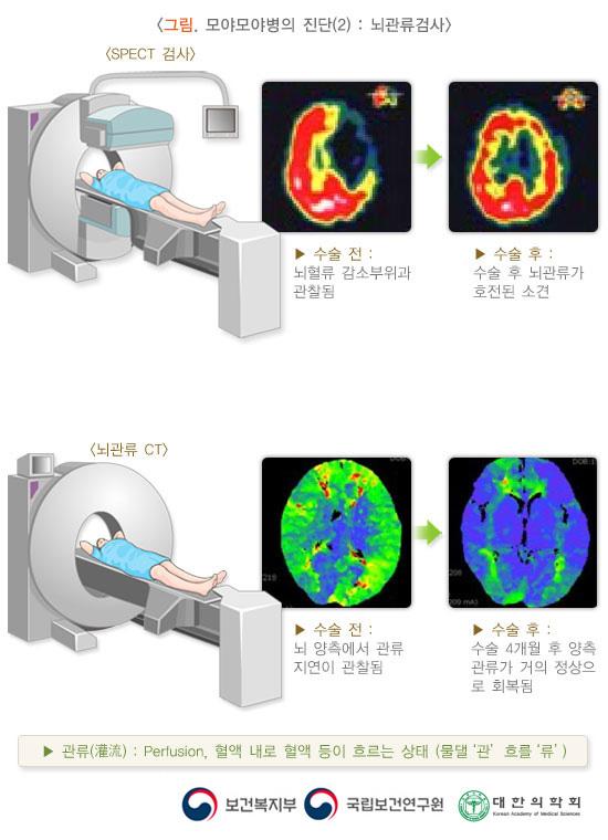 모야모야병의 진단 그림2: 뇌관류검사. SPECT검사. 수술 전: 뇌혈류 감소부위과 관촬됨 > 수술 후: 수술 후 뇌관류가 호전된 소견. 뇌관류CT. 수술 전: 뇌 양측에서 관류 지연이 관찰됨. 수술 후: 수술 4개월 후 양측 관류가 거의 정상으로 회복됨. 관류: Perfusion, 혈액 내로 혈액 등이 흐르는 상태(물댈 관 흐를 류). 보건복지부, 국립보건연구원, 대한의학회