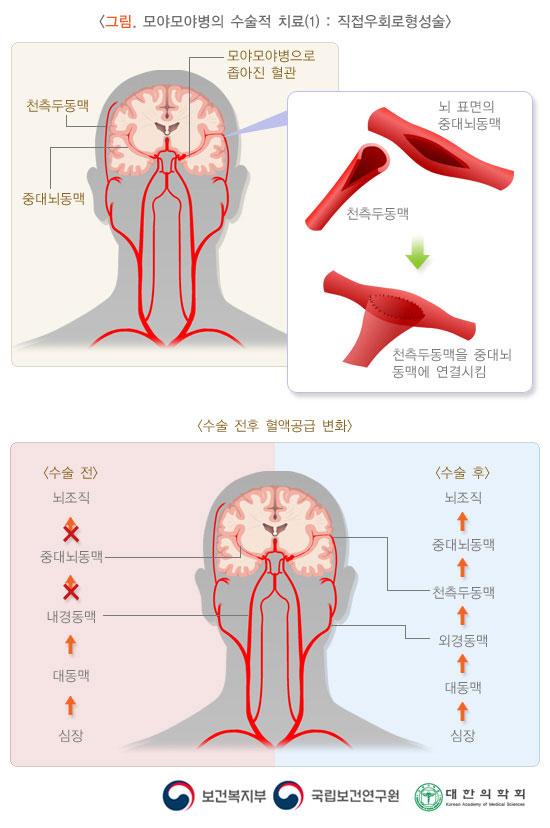 그림. 모야모야병의 수술적 치료(1): 직접우회로형성술. 모야모야병으로 좁아진 혈관. 뇌 표면의 중대뇌동맥과 천측두동맥을 절개하여 천측두동맥을 중대뇌동맥에 연결시킴. 수술 전후 혈액공급 변화. 수술 전: 심장> 대동맥> 내경동맥. 수술 후: 심장: 대동맥> 외경동맥> 천측두동맥> 종대뇌동맥> 뇌조직. 보건복지부, 국립보건연구원, 대한의학회