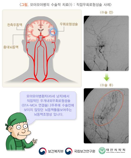 그림. 모야모야병의 수술적 치료(1): 직접우회로형성술 사례. 수술 전과 수술 후 뇌동맥조영상 이미지. 모야모야병환자(45세 남자)에서 직접적인 두개내외우회로형성술(STA-MCA 연결술) 2주후에 수술전에 보이지 않았던 뇌동맥들을 보여주는 뇌동맥조영상 입니다. 보건복지부, 국립보건연구원, 대한의학회.