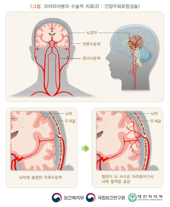 그림. 모야모야병의 수술적 치료(2): 간접우회로형성술. 뇌막에 봉합된 천측두동맥> 혈관이 뇌 속으로 자라들어가서 뇌에 혈액을 공급. 보건복지부, 국립보건연구원, 대한의학회.