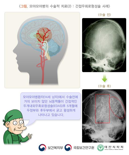 그림. 모야모야병의 수술적 치료(2): 간접우회로형성술 사례. 모야모야병환자(14세 남자)에서 수술전에 거의 보이지 않던 뇌동맥들이 간접적인 두개내외회로형성술(EDAS)후 5개월에 두정부와 후두부에서 굵고 왕성하게 나타나고 있습니다. 보건복지부, 국립보건연구원, 대한의학회.