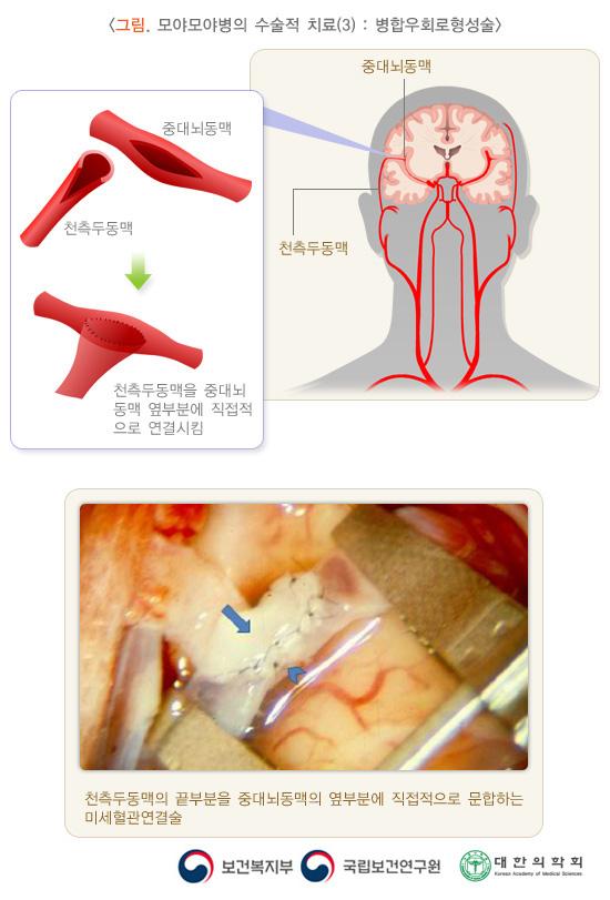 그림. 모야모야병의 수술적 치료(3): 병합우회로형성술. 중대뇌동맥과 천측두동맥을 절개해서 천측두동맥을 중대뇌동맥 옆부분에 직접적으로 연결시킴. 천측두몽맥의 끝부분을 둥대뇌동맥의 옆부분에 직접적으로 문합하는 미세혈관연결술 예시이미지. 보건복지부, 국립보건연구원, 대한의학회