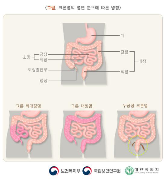 크론병의 병변 분포에 따른 명칭 그림. 크론 회대장염, 크론 대장염, 누공성 크론병. 보건복지부, 국립보건연구원, 대한의학회