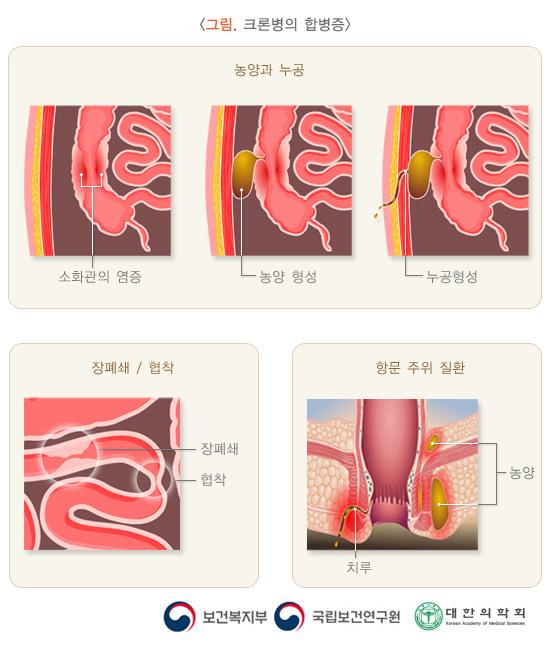 크론병의 합병증 그림. 농양과 누공: 소화관의 염증, 농양 형성, 누공형성. 장폐쇄/협착. 항문 주위 질환: 농양, 치루. 보건복지부, 국립보건연구원, 대한의학회