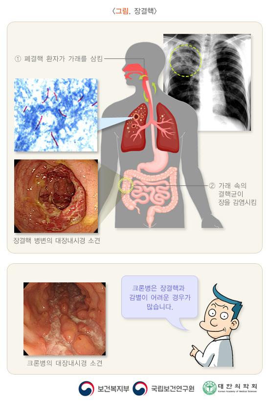 장결핵 그림. 1. 폐결핵 환자가 가래를 삼킴. 2. 가래 속의 결핵균이 장을 감염시킴. 장결핵 병변의 대장내시경 소견 사진. 크론병의 대장내시경 소견 사진. 크론병은 장결핵과 감별이 어려운 경우가 많습니다. 보건복지부, 국립보건연구원, 대한의학회
