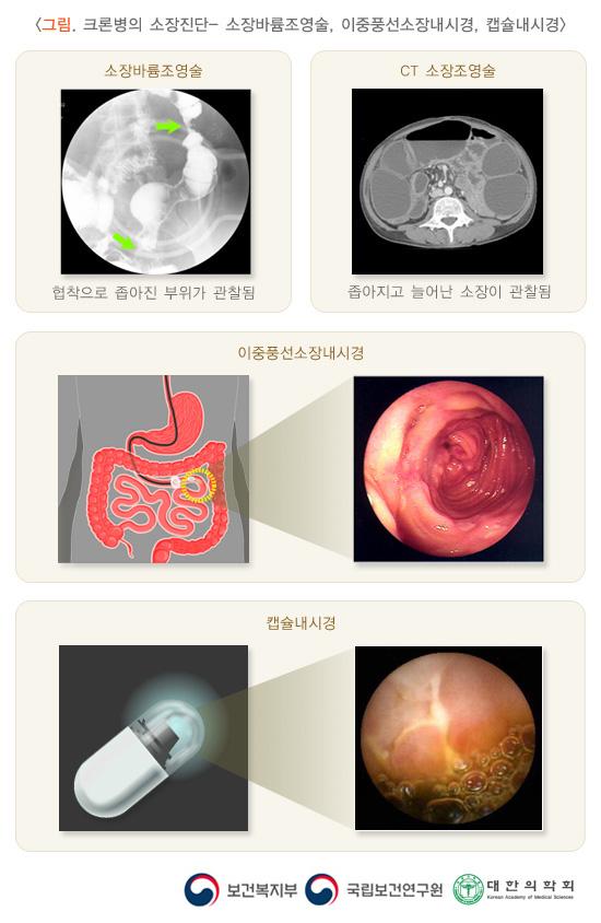 크론병의 소장진단- 소장바륨조영술, 이중풍선소장내시경, 캡슐내시경. 소장바륨조영술: 협착으로 좁아진 부위가 관찰됨. CT 소장조영술: 좁아지고 늘어난 소장이 관찰됨. 이중풍선소장내시경 사진. 캠슐내시경 사진. 보건복지부, 국립보건연구원, 대한의학회