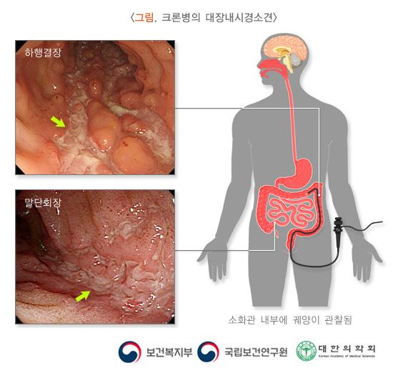 크론병의 대장내시경소견 그림. 하행결장, 말단회장. 소화관 내부에 궤양이 관찰됨. 보건복지부, 국립보건연구원, 대한의학회