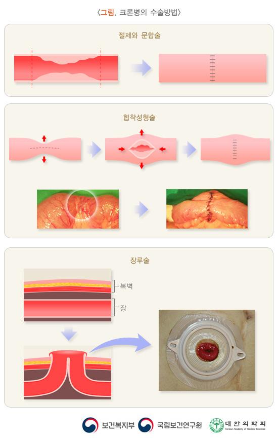 크론병의 수술방법 그림. 절제와 문합술, 협착성형술, 장루술. 보건복지부, 국립보건연구원, 대한의학회