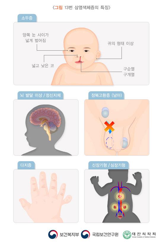13번 삼염색체증의 특징
