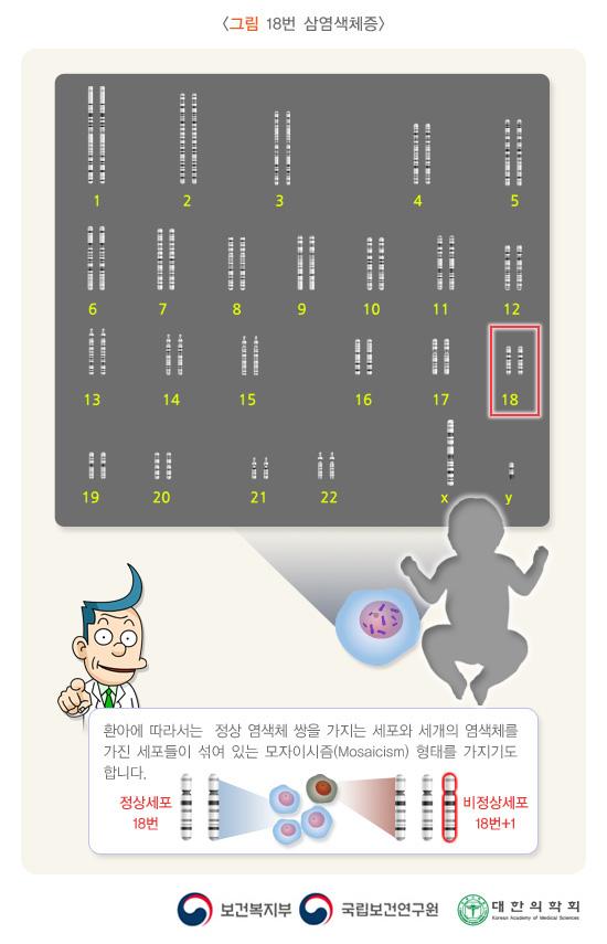 18번 삼염색체증/환아에 따라서는 정상 염색체 쌍을 가지는 세포와 세개의 염색체를 가진 세포들이 섞여 있는 모자이시즘(Mosaicism) 형태를 가지기도 합니다./정상세포18번/비정상세포18번+1