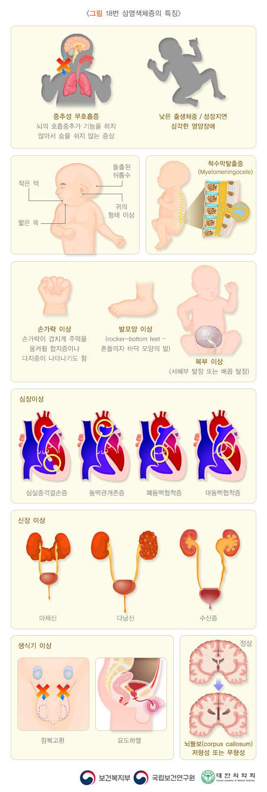 18번 삼염색체증의 특징/중추성무호흡증 뇌의호흡중추가 기능을 하지 않아서 숨을 쉬지 않는 증상/낮은 출생체중/성장지연심각한 영양장애/작은 턱,짧은 목, 돌출된 뒤통수,귀의 형태이상/척수막탈출중(Myelomeningocele)/손가락 이상 손가락이 겹치게 주먹을 움켜쥠 합지증이나 다지증이 나타나기도함/발모양 이상(rocker-bottom feet-흔들의자 바닥 모양의 발)/복부 이상(서혜부 탈장 또는 배꼽탈장)/심장이상 심실중격손증 동맥관개존증 폐동매협착증 대동맥 협착증/신장 이상 마제신 다낭신 수신증/생식기 이상 잠복고환 요도하열/뇌들보(corpus callosum)저형성 또는 무형성