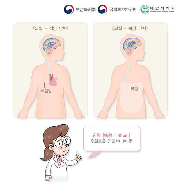 뇌실-복강 단락