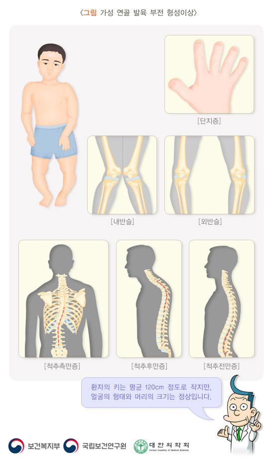 가성 연골 발육 부전 형성이상