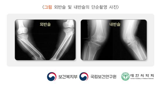 외반슬 및 내반슬의 단순촬영 사진