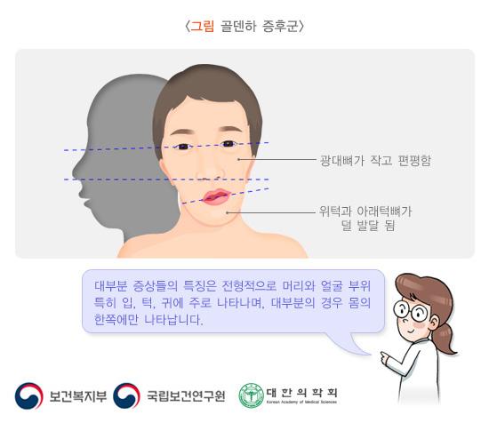 골덴하 증후군
