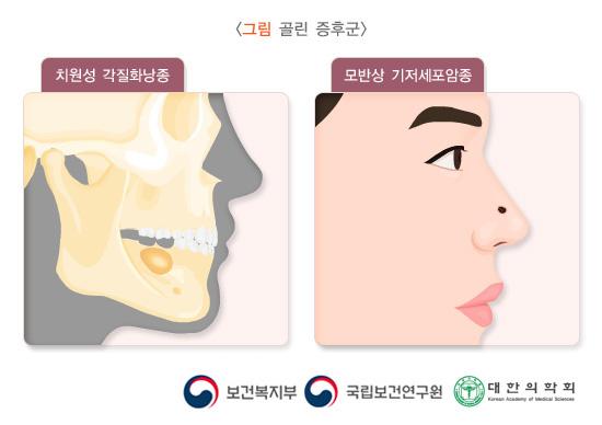 골린 증후군: 치원성 각질화낭종, 모반상 기저세포암종의 그림