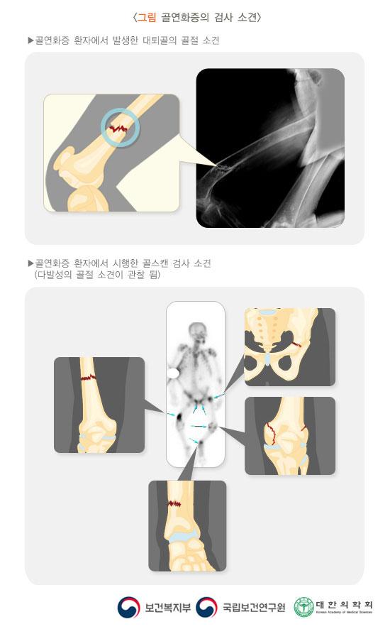 골연화증의 검사 소견