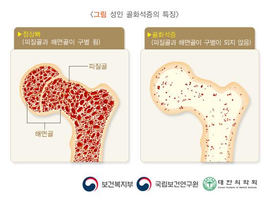 성인 골화석증의 특징