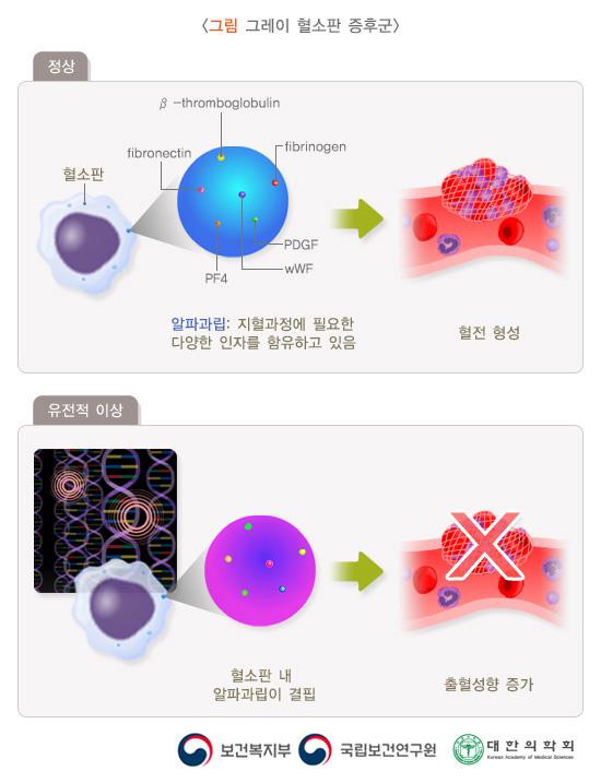 그레이 혈소판 증후군