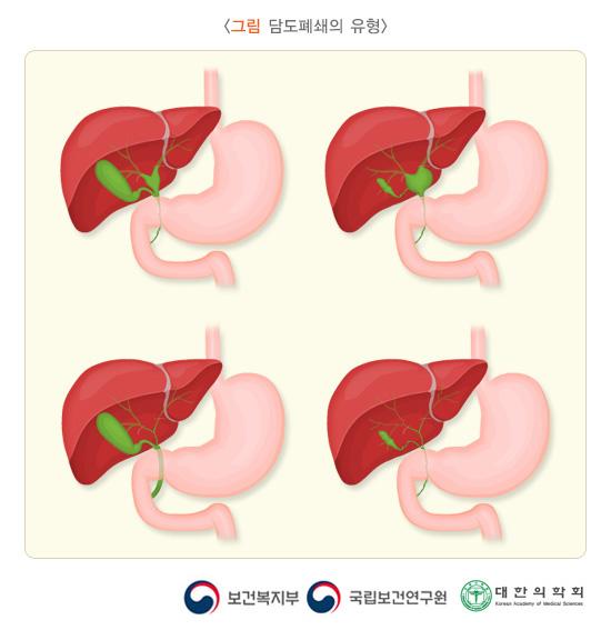 담도폐쇄의 유형