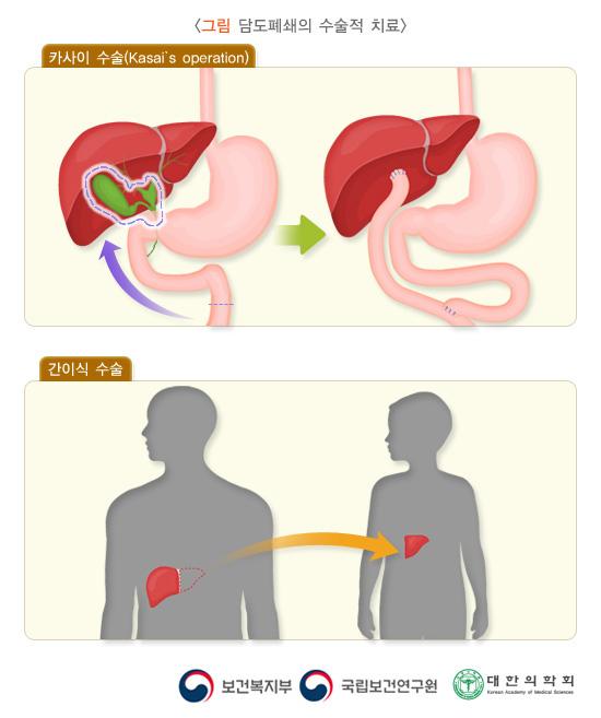 담도폐쇄의 수술적 치료