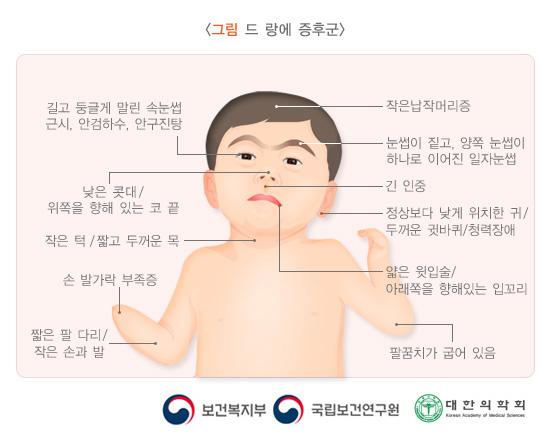 드 랑에 증후군