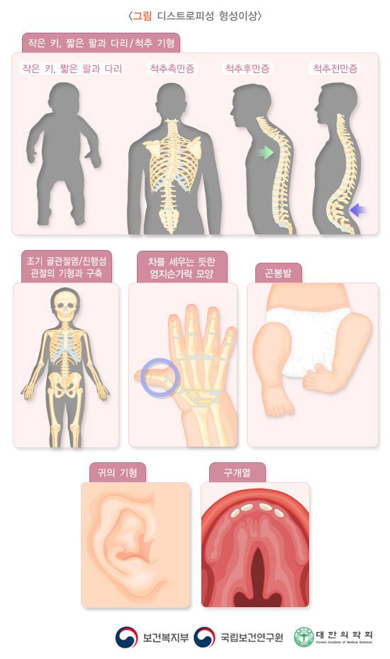 디스트로피성 형성이상