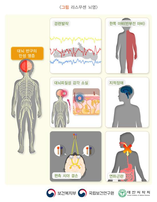 라스무센 뇌염: 대뇌의 반구에 만성 염증(뇌염)이 특징이고 경련발작, 한쪽 마비(반부전 마비)와 지적장애, 대뇌피질성 감각 소실, 편측 시야 결손, 연하곤란 등의 증상 그림