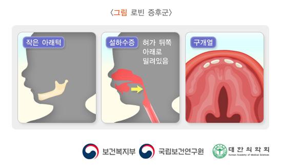 로빈 증후군