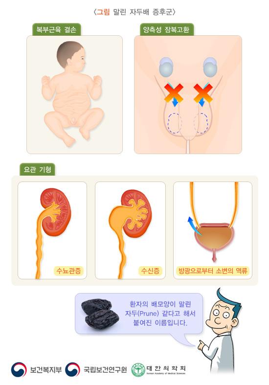 말린자두배증후군