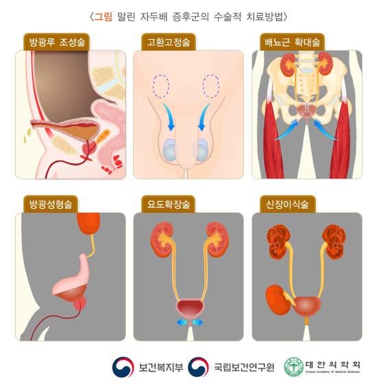 말린자두배증후군의 수술적 치료방법