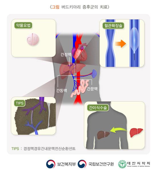 버드-키아리 증후군의 치료 방법 그림. 간정맥, 간동맥, 간문맥. 양물요법, 혈관확장술, TIPS, 간이식수술. TIPS: 경정맥경유간내문맥전신순환션트. 보건복지부, 국립보건연구원, 대한의학회