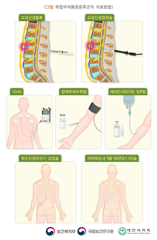 복합부위통증증후군의 치료방법은 교감신경블록, 교감신경절제술, TENS, 정맥부위마취법, 케타민/리도카인 정주법, 척수신경자극기 삽입술, 지주막하강 내 약물 지속주입기 이식술이 있습니다. 보건복지부, 국립보건연구원, 대한의학회.