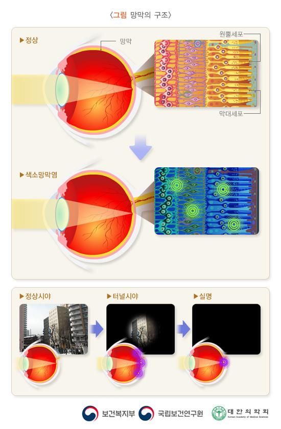 망막의 해부학적 구조 그림. 정상 안구의 망막, 원뿔세포, 막대세포> 색소망막염. 정상시야>터널시야>실명.  보건복지부, 국립보건연구원, 대한의학회