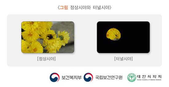 정상시야와 터널시야 비교 이미지. 보건복지부, 국립보건연구원, 대한의학회