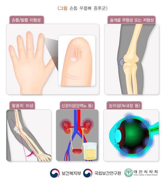 손톱 무릎뼈 증후군