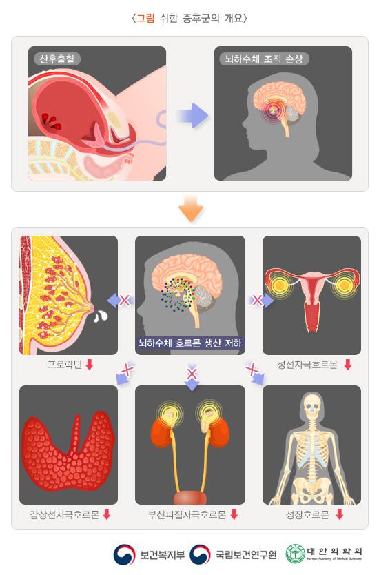 쉬한 증후군의 개요