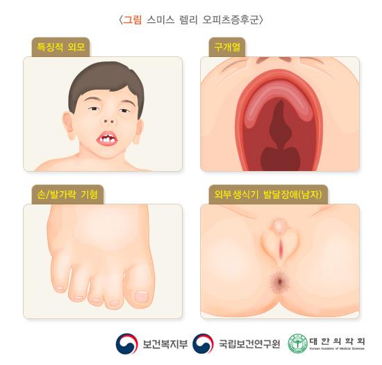 스미스-렘리-오피츠 증후군