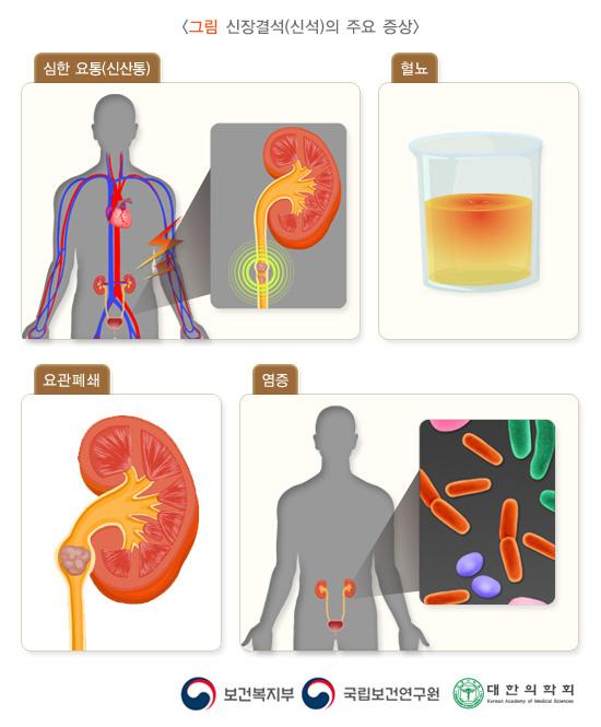 신장결석(신석)의 주요 증상