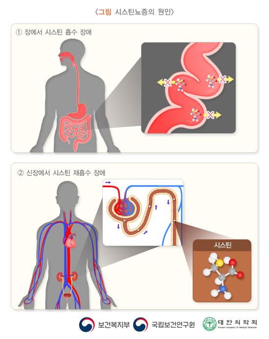 시스틴뇨증의 원인